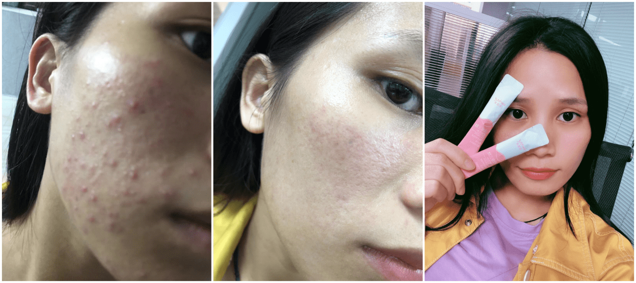 最新痘痘治疗，从自卑到自信的肌肤重生之路