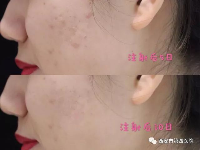 蛇泡疮最新治疗方法，爱与陪伴的力量，奇遇记分享